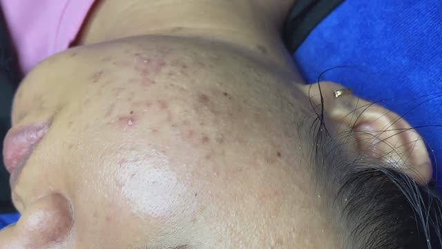 Лечение прыщей для смуглой кожи - SDS#273 смотреть онлайн