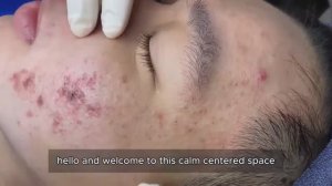 Механическое очищение кожи от комедонов: техника. #10015903