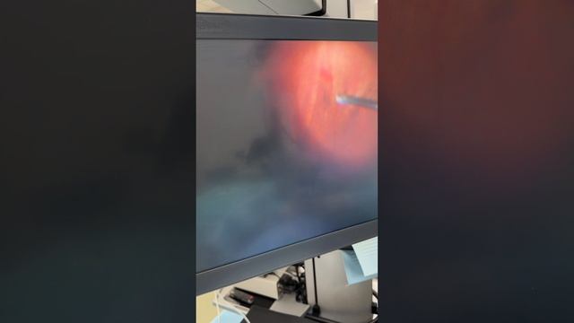 Персистирующая гиалоидная артерия у ребенка 11 лет.