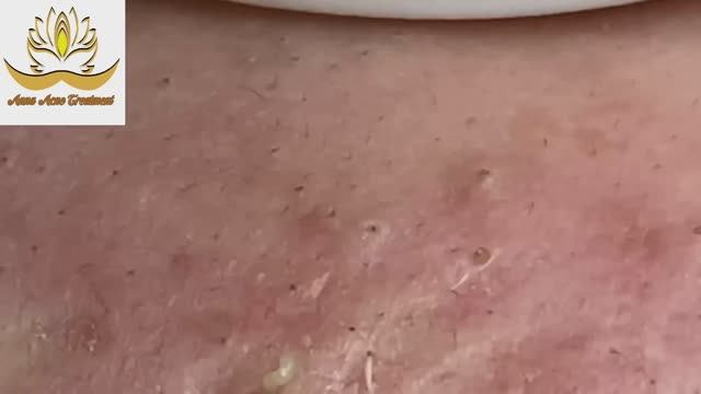 Избавление от прыщей. Расслабляющее видео. #001 смотреть онлайн