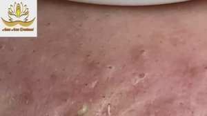 Избавление от прыщей. Расслабляющее видео. #001