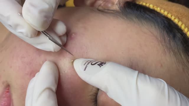 Черные точки, глубокие скрытые прыщи под кожей. - SDS#270 смотреть онлайн