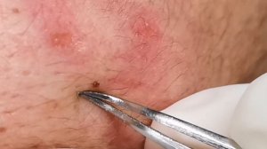 Чистка лица от угрей и акне. Выдавливание прыщей. Удаление черных точек и комедонов