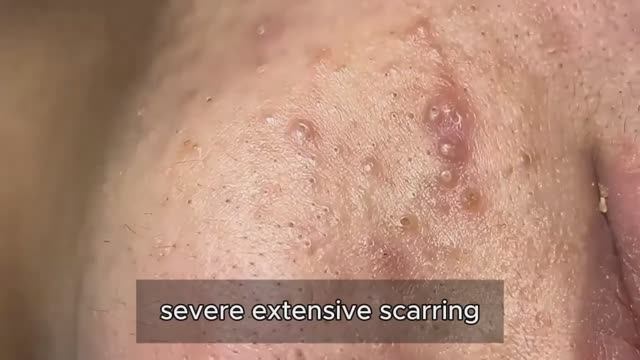 Чистка пор (удаление сальных пробок) — это освежает и успокаивает #23569019 смотреть онлайн