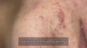 Чистка пор (удаление сальных пробок) — это освежает и успокаивает #23569019