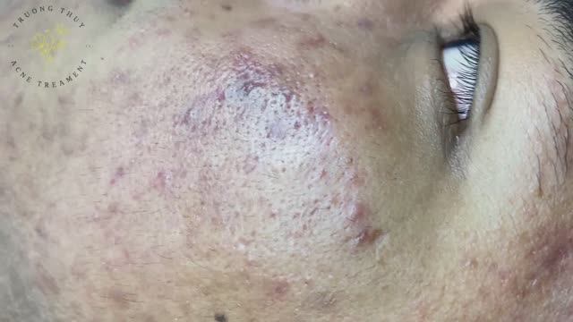 Чистим лицо от комедонов. Механический метод (#138) смотреть онлайн