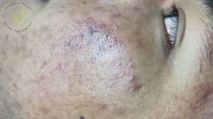 Чистим лицо от комедонов. Механический метод (#138)