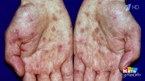 Сифилис у мужчин: скрытая угроза. Жить здорово! Фрагмент выпуска от 25.02.2026