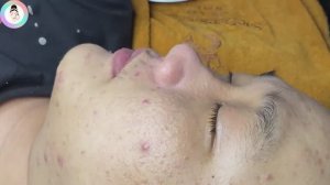Удаление прыщей + выдавливание жирных прыщей, расслабляющий просмотр
