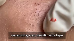 Гид по удалению черных точек: очищение пор