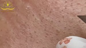 Asmr. Профессиональное очищение от черных точек. #004