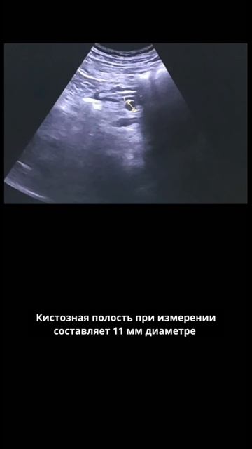 #вирсунгов проток