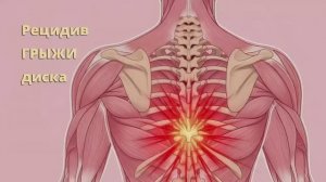 Рецидив грыжи диска