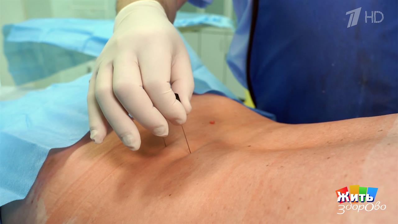 Боль в спине: от врача - к жизни. Жить здорово! Фрагмент выпуска от 25.02.2026 смотреть онлайн