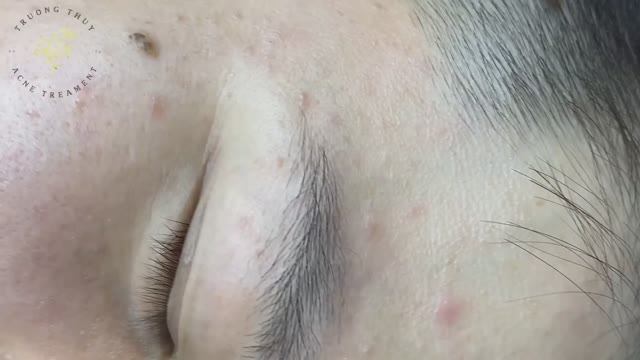 Профессиональное очищение кожи от комедонов. Техника (#141) смотреть онлайн