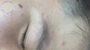 Профессиональное очищение кожи от комедонов. Техника (#141)