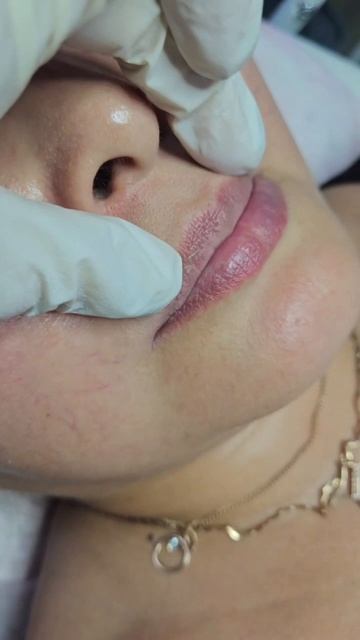 Контурная пластика губ смотреть онлайн