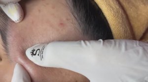 Лечим прыщи: от комедона до воспаления. (#137)