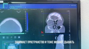 Септопластика и гайморотомия в один этап.