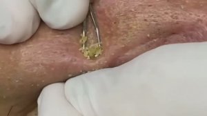 Чистка лица от угрей и акне. Выдавливание прыщей. Удаление черных точек и комедонов