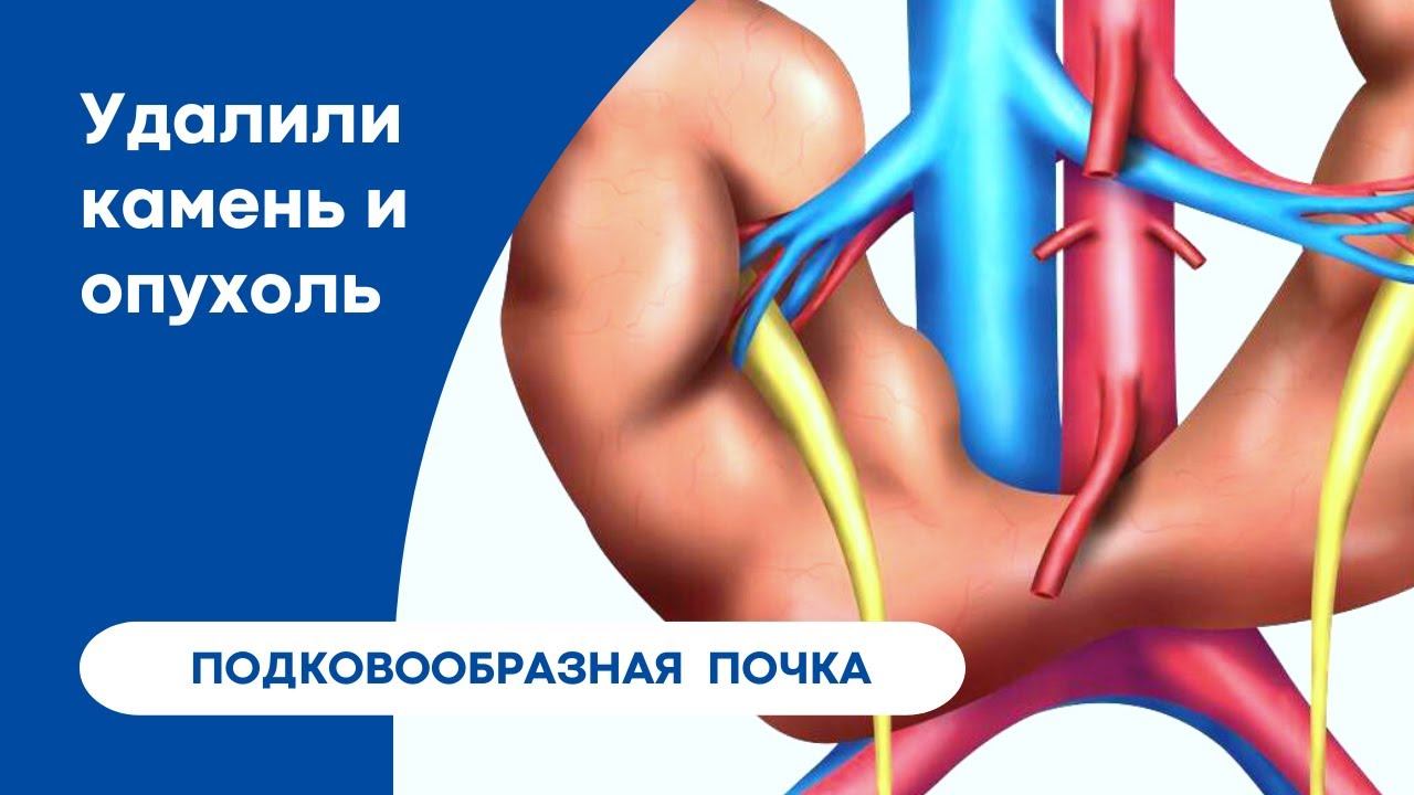 Удаление опухоли и камня подковообразной почки