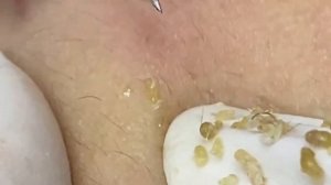 Выдавливание прыщей, угрей, черных точек и камедонов #204