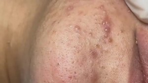 Asmr. Чистим кожу от сальных пробок и прыщей.