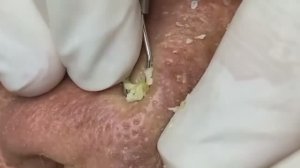 Чистка лица от угрей и акне. Выдавливание прыщей. Удаление черных точек и комедонов