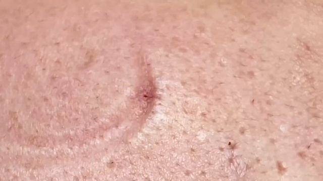 Asmr. Удаление подкожных угрей, комедонов. Win #126 смотреть онлайн