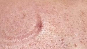 Asmr. Удаление подкожных угрей, комедонов. Win #126