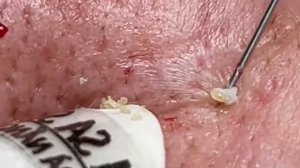 Профессиональная чистка от прыщей и сальных пробок. # 054