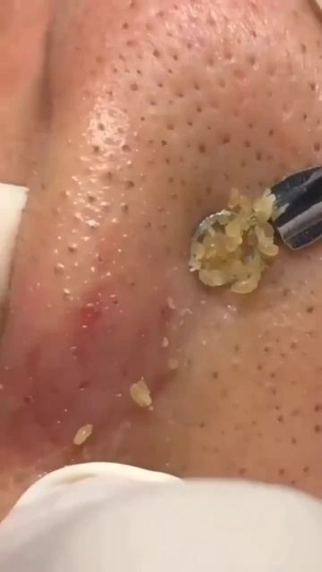 Чистка лица от угрей и акне. Выдавливание прыщей. Удаление черных точек и комедонов смотреть онлайн