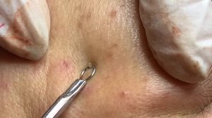 Избавляемся от прыщей и восстанавливаем кожный барьер