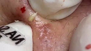 Asmr. Избавление от черных точек. # 055