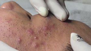 Asmr. Механическое очищение от сальных пробок. #103(Linh)P1