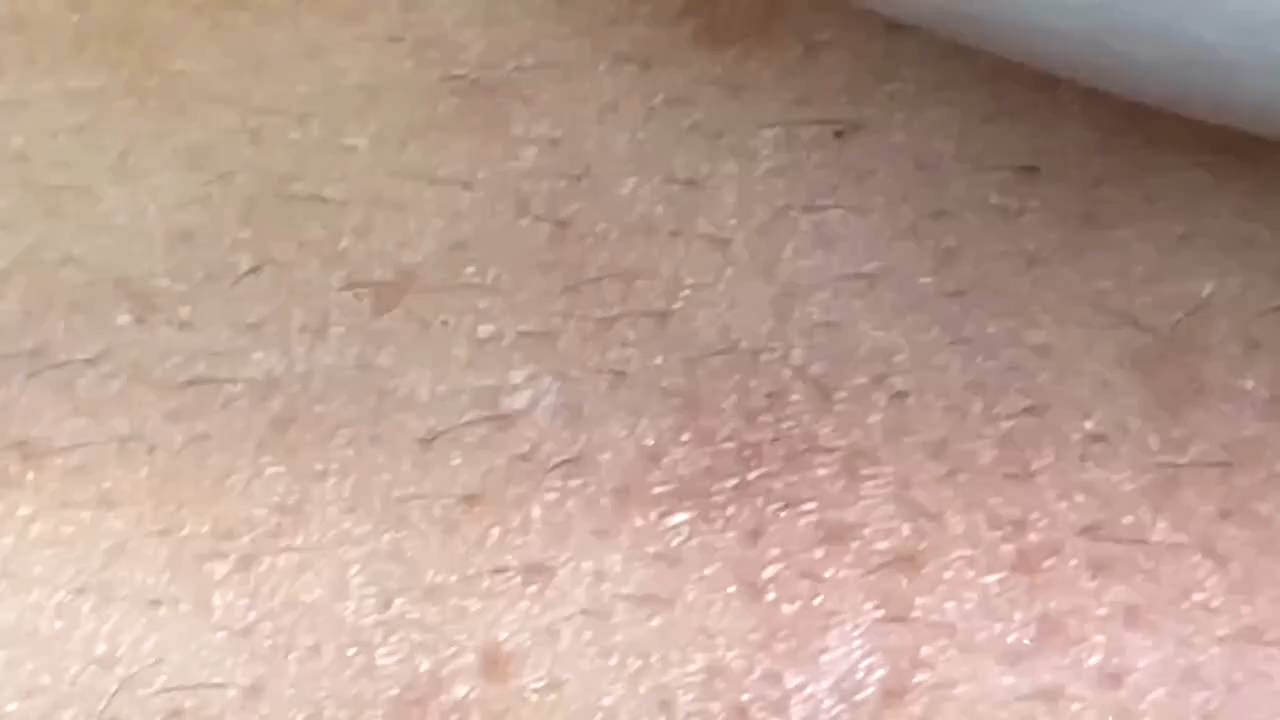 Чистка кожи от прыщей и черных точек: комплексный подход. смотреть онлайн