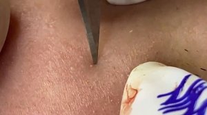 Asmr. Чистка кожи от черных точек. Win #125