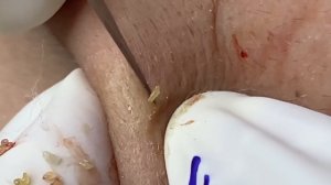 Asmr. Убирание сальных пробок. Win #131