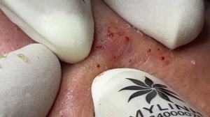 Asmr. Механическое очищение от сальных пробок. #103(Linh)P1