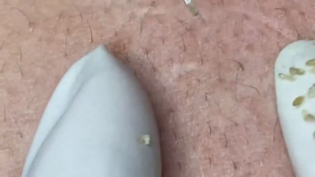 Выдавливание прыщей, угрей, черных точек и камедонов #209 смотреть онлайн