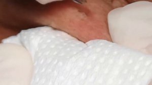 Чистка лица от угрей и акне. Выдавливание прыщей. Удаление черных точек и комедонов