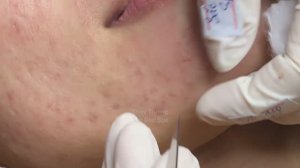 Длительное наличие закрытых комедонов (белых угрей) приводит к рубцам на лице Truong#2