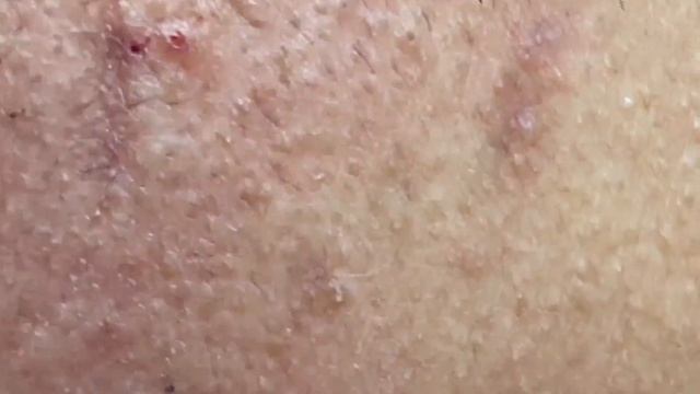 Профессиональное удаление комедонов Win#132 смотреть онлайн