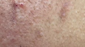 Профессиональное удаление комедонов Win#132