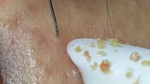 Глубокое очищение кожи от прыщей без скрабирования.