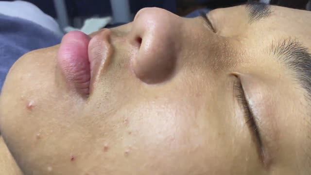 Глубокая чистка кожи от комедонов: результаты. смотреть онлайн