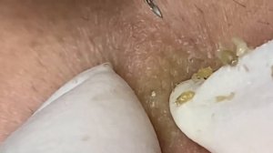 Выдавливание прыщей, угрей, черных точек и камедонов #208