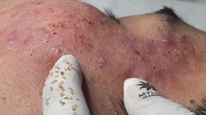 Asmr. Механическое очищение от сальных пробок. #104(Linh)P2