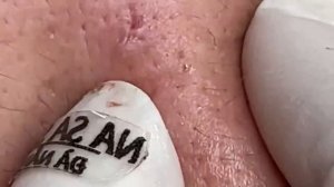 Чистка лица от прыщей: дешево и эффективно. # 056