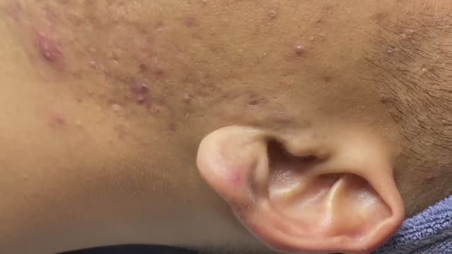 Полное избавление от прыщей смотреть онлайн